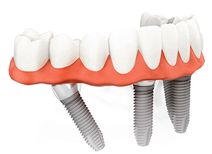 implantattyp_all-on-4-1