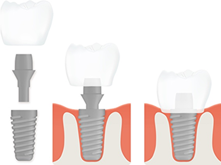 implantattyp_einzelimplantat