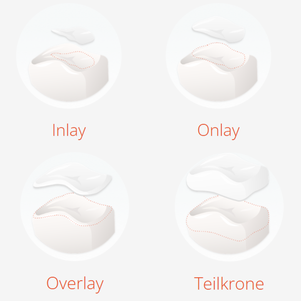 Zahnfüllungen: Inlay, Onlay, Overlay, Teilkrone im Vergleich.